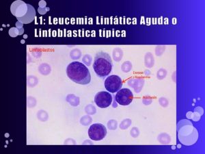 leucemia-linfatica-aguda-2-728
