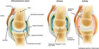 Artrosi e artrite